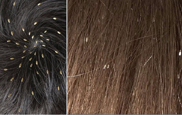 Как развиваются гниды на волосах