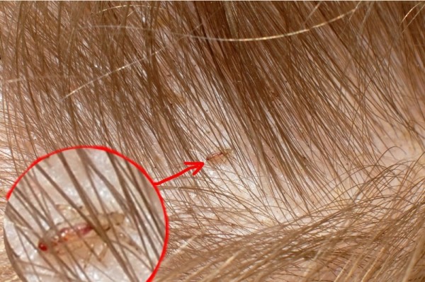 Как развиваются гниды на волосах
