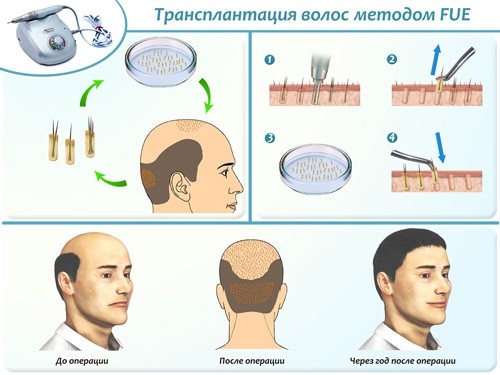 Трансплантация волос 