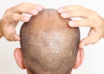 Пересадка волос: за и против, отзывы пациентов